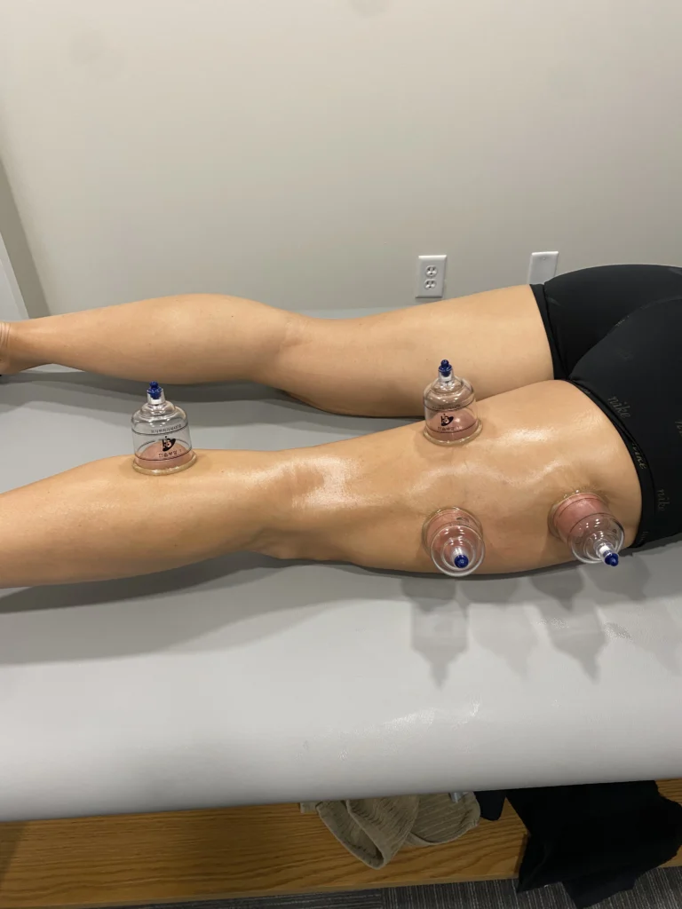 Cups on leg of patient, through cupping therapy.