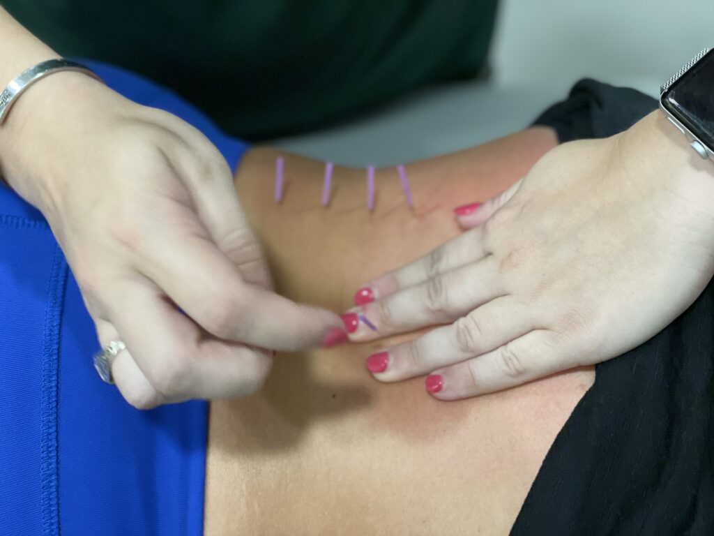 Chiropractor placing dry needles in patients back.