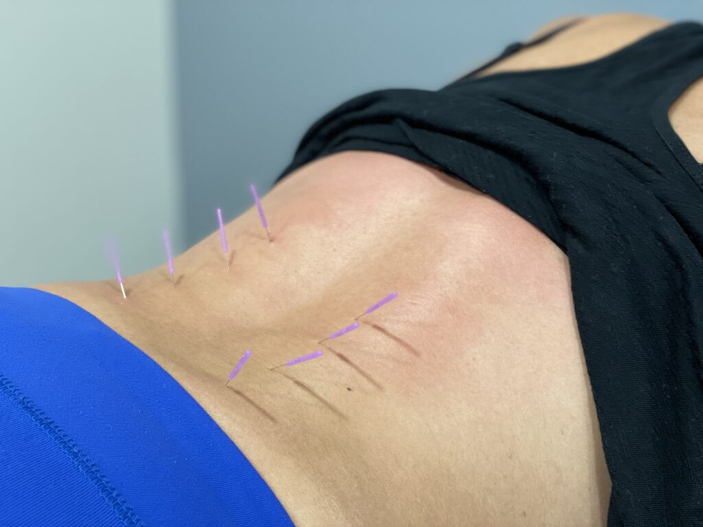 Dry needles in patients back